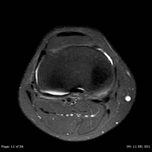 File:Anterior cruciate ligament tear (Radiopaedia 70783-80964 Axial PD fat sat 11).jpg