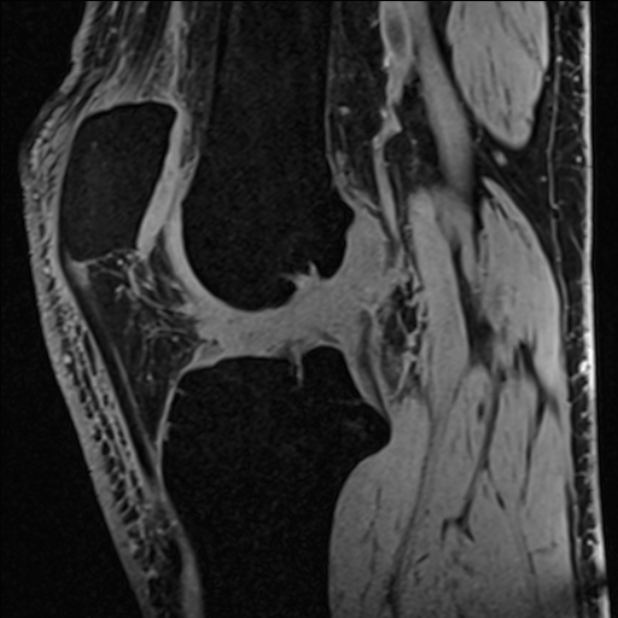 Anterior cruciate ligament tear - ramp lesion (Radiopaedia 71883-82322 Sagittal T1 vibe 72).jpg