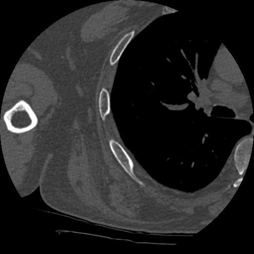 Anterior glenohumeral dislocation with Hill-Sachs lesion (Radiopaedia 62877-71249 Axial bone window 87).jpg