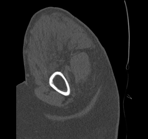 Anterior glenohumeral dislocation with Hill-Sachs lesion (Radiopaedia 62877-71249 Sagittal bone window 17).jpg