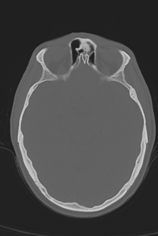 Anterior nasal spine fracture (Radiopaedia 46138-50494 Axial bone window 35).png