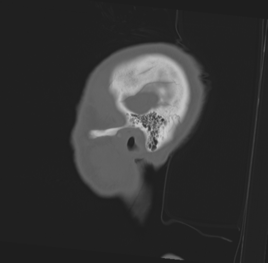 Anterior nasal spine fracture (Radiopaedia 46138-50494 Sagittal bone window 8).png