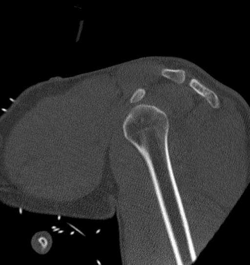 Anterior shoulder dislocation with Hill-Sachs and bony Bankart lesions (Radiopaedia 40424-42974 Sagittal bone window 19).png