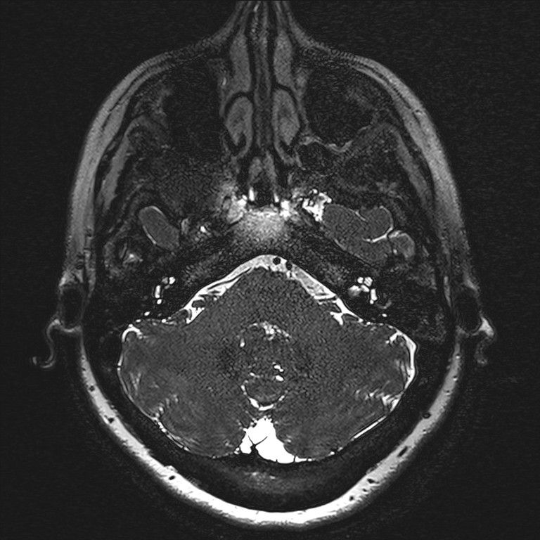 Anterior temporal encephalocele (Radiopaedia 82624-96808 Axial T2 high res 6).jpg