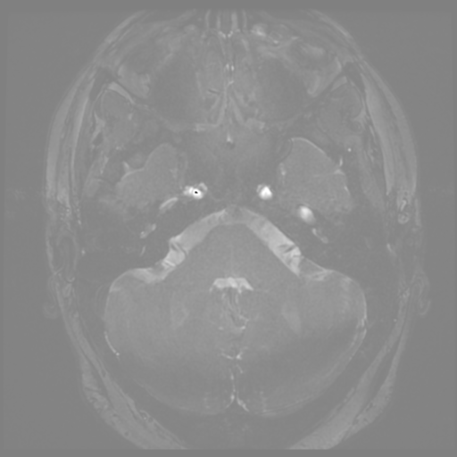 Anterior temporal lobe perivascular space (Radiopaedia 68481-78041 E 4).png