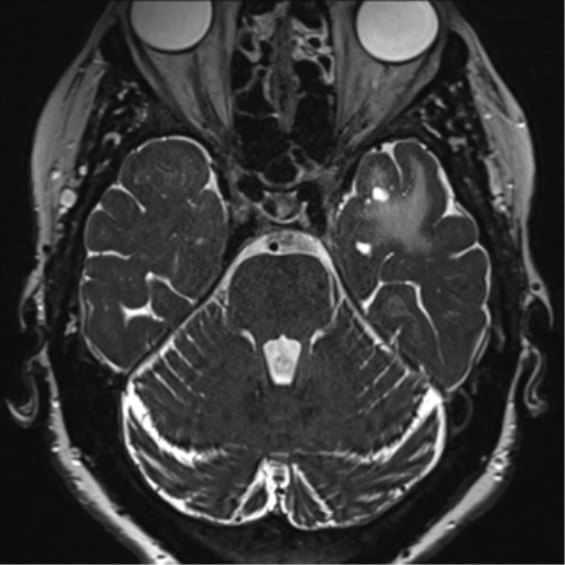 Anterior temporal pole cysts (Radiopaedia 46629-51102 Axial 27).png