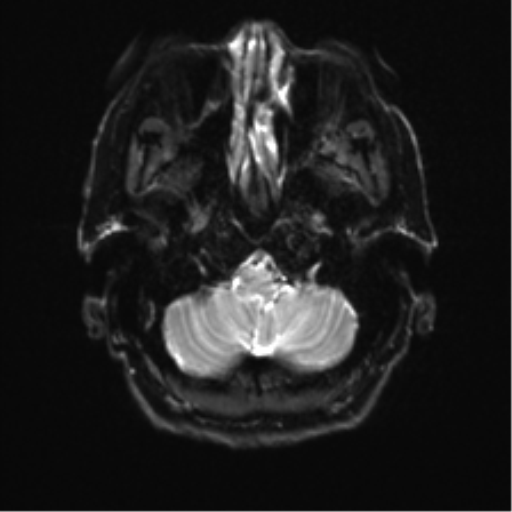 Anterior temporal pole cysts (Radiopaedia 46629-51102 Axial DWI 4).png