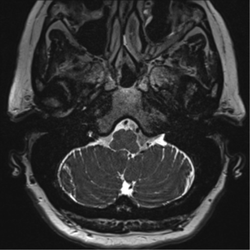Anterior temporal pole cysts (Radiopaedia 46629-51102 Axial T2 15).png