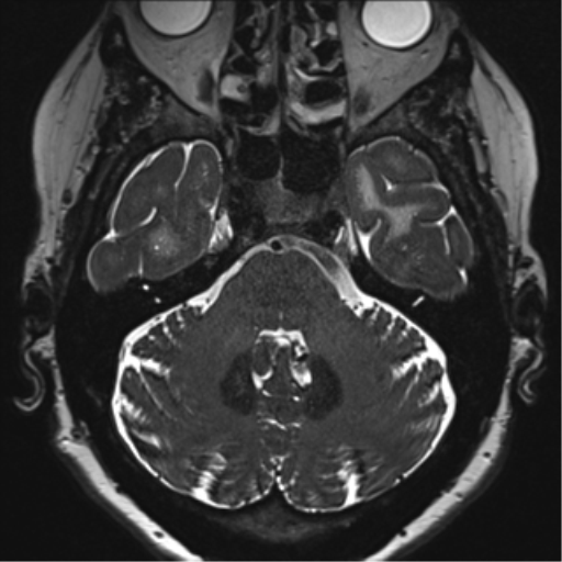 Anterior temporal pole cysts (Radiopaedia 46629-51102 Axial T2 41).png