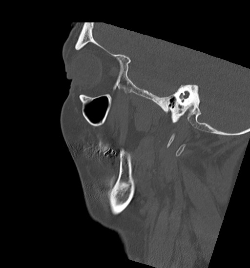 Anterior temporomandibular joint dislocation (Radiopaedia 59430-66784 B 49).jpg