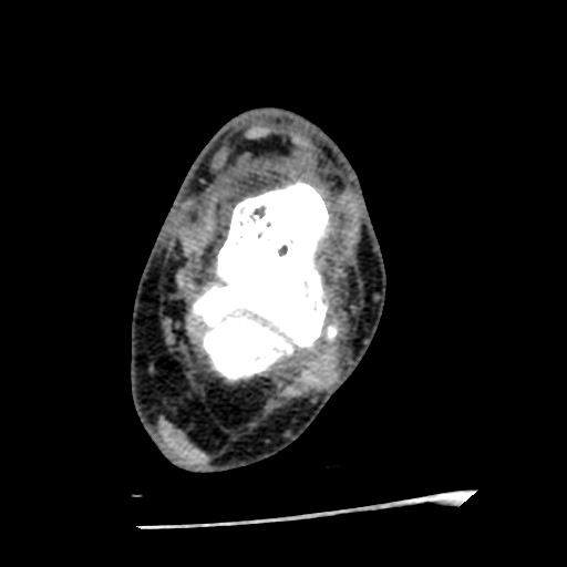 File:Anterior tibial artery false aneurysm (Radiopaedia 88984-105809 A 148).jpg
