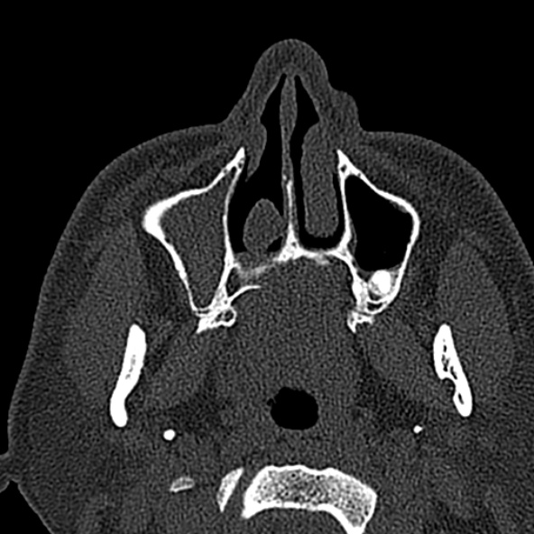 Antrochoanal polyp (Radiopaedia 30002-30554 Axial bone window 15).jpg
