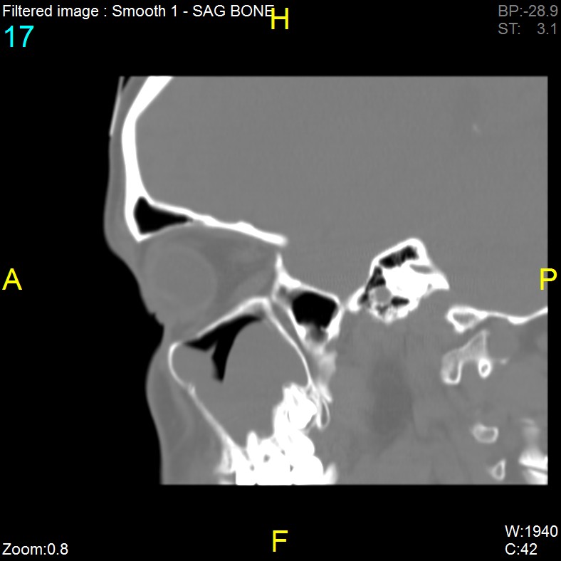 Antrochoanal polyp (Radiopaedia 65101-74094 Sagittal bone window 17).jpg