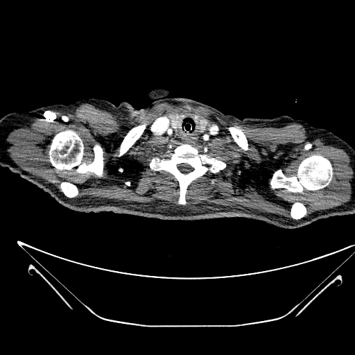Aortic arch aneurysm (Radiopaedia 84109-99365 B 29).jpg