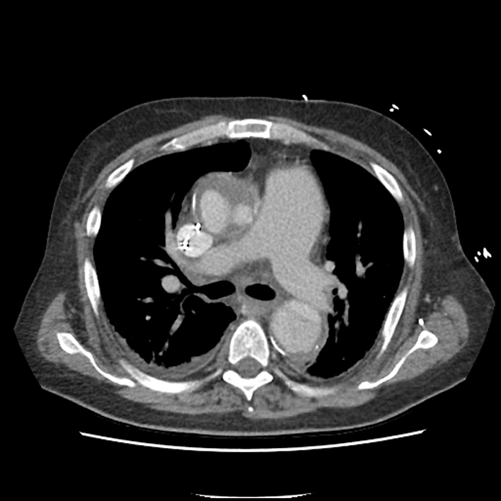 Aortic arch graft infection (FDG PET-CT) (Radiopaedia 71975-82437 A 23).jpg