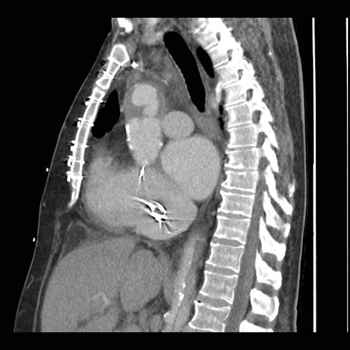 Aortic arch graft infection (FDG PET-CT) (Radiopaedia 71975-82437 C 33).jpg