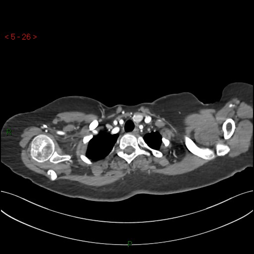 Aortic arch origin of left vertebral artery (Radiopaedia 51520-57286 A 25).jpg