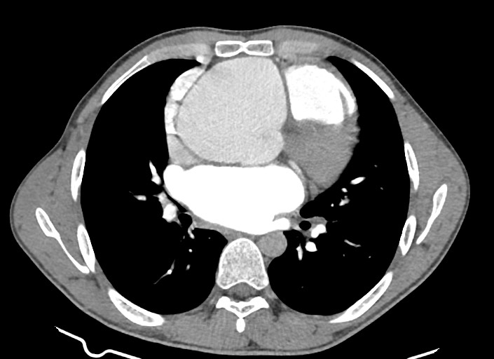 File:Aortic coarctation with aneurysm (Radiopaedia 74818-85828 A 108).jpg