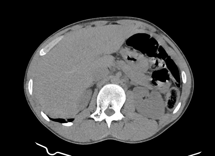 File:Aortic coarctation with aneurysm (Radiopaedia 74818-85828 A 21).jpg