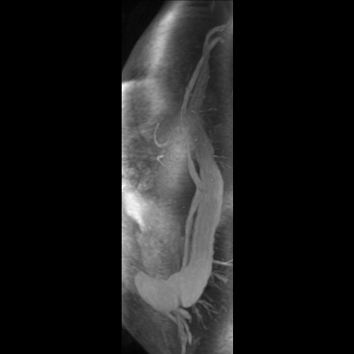File:Aortic dissection - Stanford A - DeBakey I (Radiopaedia 23469-23551 D 17).jpg