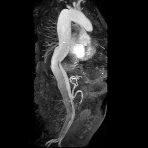 File:Aortic dissection - Stanford A - DeBakey I (Radiopaedia 23469-23551 MRA 9).jpg