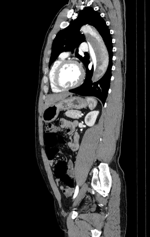 Aortic dissection - Stanford type A (Radiopaedia 83418-98500 B 61).jpg