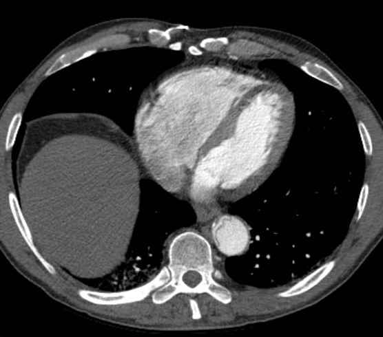 Aortic dissection - Stanford type B (Radiopaedia 73648-84437 A 81).jpg