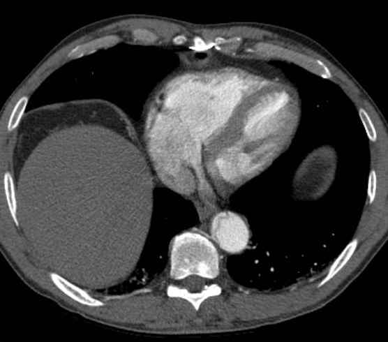 Aortic dissection - Stanford type B (Radiopaedia 73648-84437 A 86).jpg