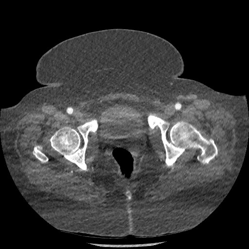 Aortic dissection - Stanford type B (Radiopaedia 88281-104910 A 159).jpg