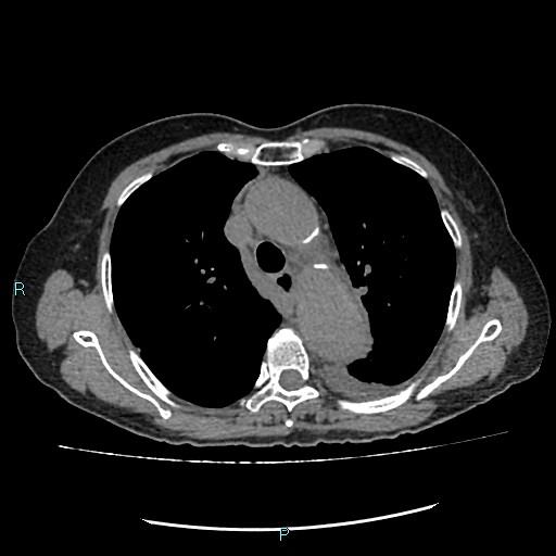 File:Aortic dissection extended to lusory artery (Radiopaedia 43686-47136 Axial non-contrast 10).jpg