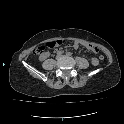 File:Aortic dissection extended to lusory artery (Radiopaedia 43686-47136 Axial non-contrast 42).jpg