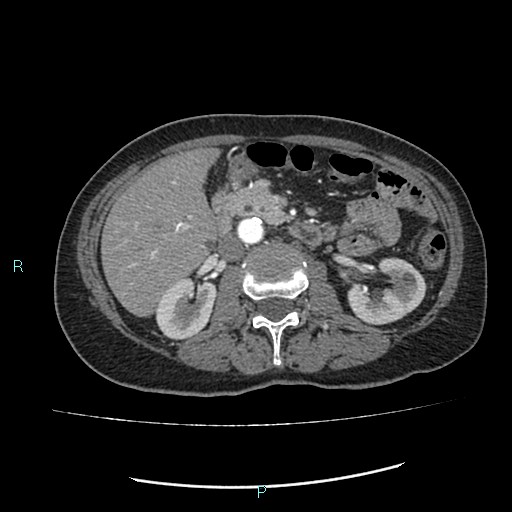 File:Aortic dissection extended to lusory artery (Radiopaedia 43686-47136 B 17).jpg