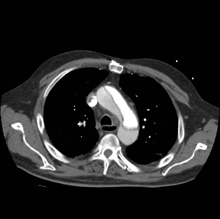 Aortic dissection with rupture into pericardium (Radiopaedia 12384-12647 A 18).jpg