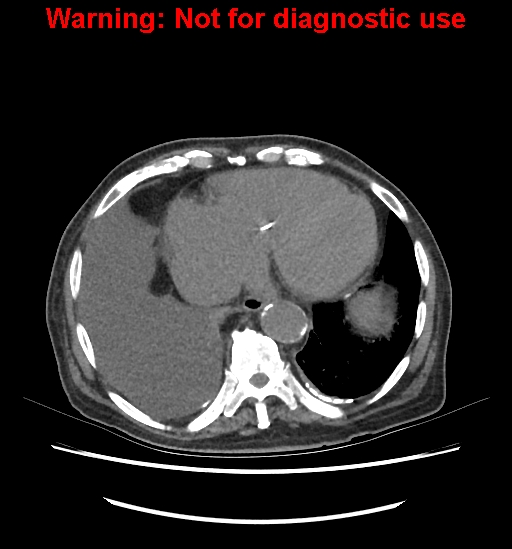 Aortic graft infection (Radiopaedia 44979-48907 Axial non-contrast 15).jpg