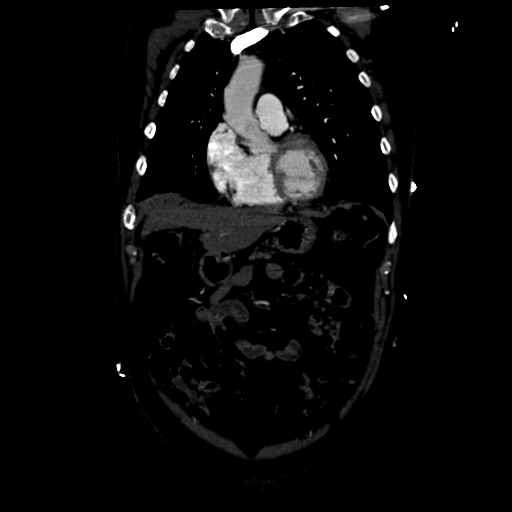 Aortic intramural hematoma (Radiopaedia 34260-35540 C 26).png
