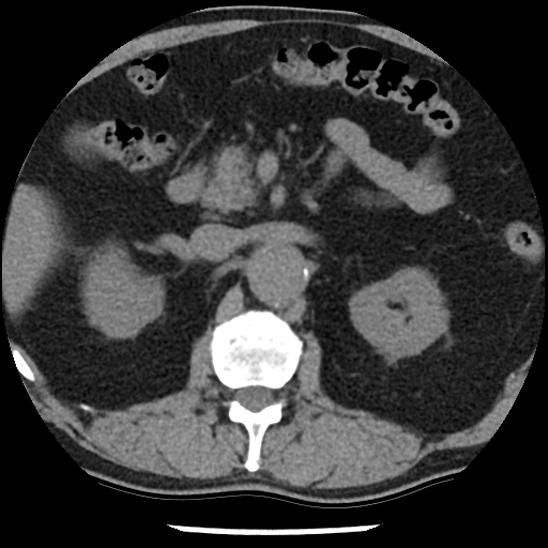 Aortic intramural hematoma (type B) (Radiopaedia 79323-92387 Axial non-contrast 63).jpg