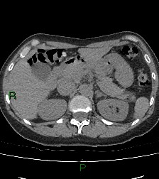 File:Aortic valve endocarditis (Radiopaedia 87209-103485 Axial non-contrast 100).jpg