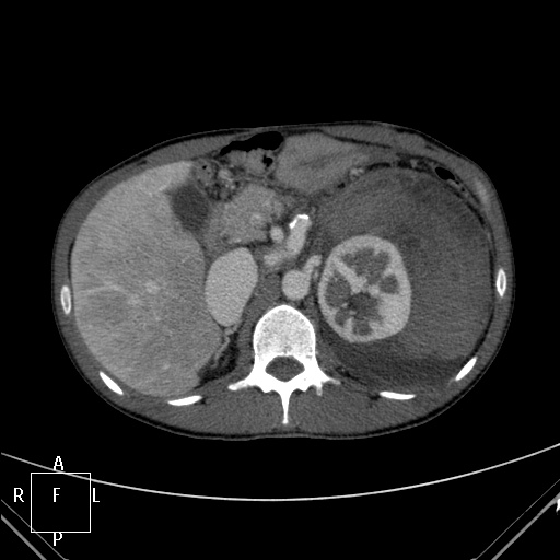 File:Aorto-left renal vein fistula (Radiopaedia 45534-49628 A 12).jpg