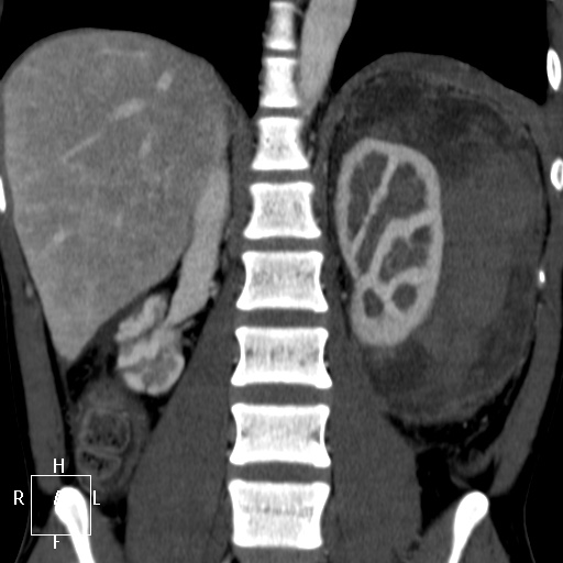 Aorto-left renal vein fistula (Radiopaedia 45534-49628 B 45).jpg