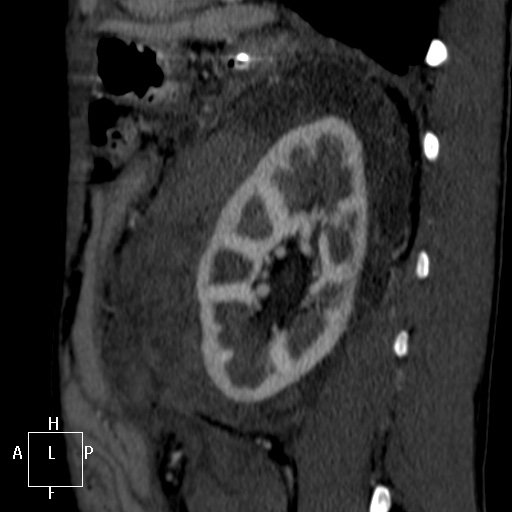 Aorto-left renal vein fistula (Radiopaedia 45534-49628 C 53).jpg