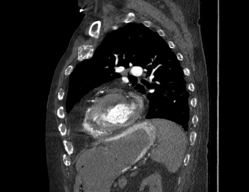 Aortoesophageal fistula with endovascular repair (Radiopaedia 73781-84592 Sagittal C+ CTPA 134).jpg