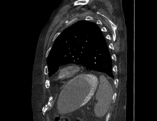 Aortoesophageal fistula with endovascular repair (Radiopaedia 73781-84592 Sagittal C+ CTPA 160).jpg