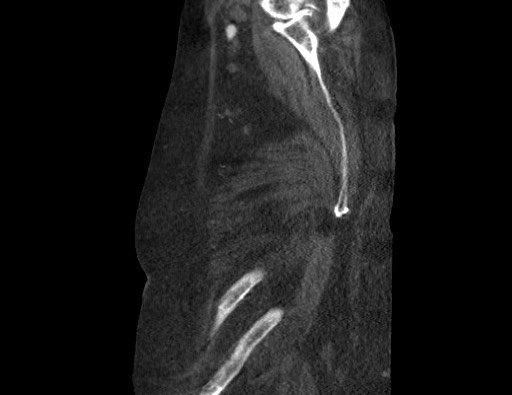 File:Aortoesophageal fistula with endovascular repair (Radiopaedia 73781-84592 Sagittal C+ CTPA 193).jpg