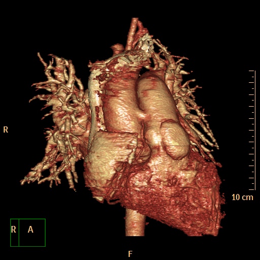 File:Aortopulmonary septal defect (Radiopaedia 41990-45013 3D reconstruction 20).jpg