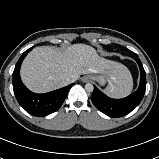 File:Apical lung mass mimic - neurogenic tumor (Radiopaedia 59918-67521 A 70).jpg
