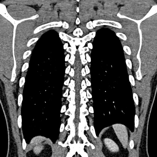 Apical lung mass mimic - neurogenic tumor (Radiopaedia 59918-67521 B 87).jpg