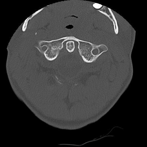 Apical pneumothorax on cervical spine CT (Radiopaedia 45343-49368 Axial bone window 13).jpg