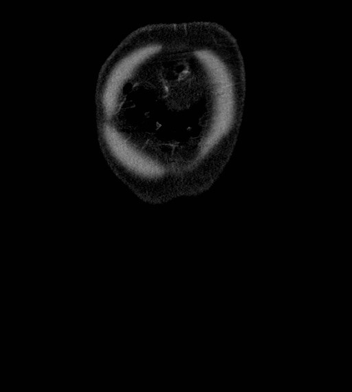 Appendiceal adenocarcinoma complicated by retroperitoneal abscess (Radiopaedia 58007-65039 A 4).jpg