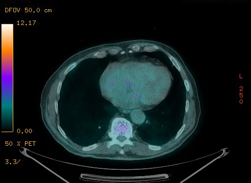 Appendiceal adenocarcinoma complicated by retroperitoneal abscess (Radiopaedia 58007-65041 Axial PET-CT 87).jpg