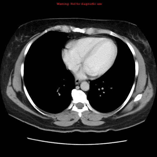 Appendiceal mucinous cystadenoma (Radiopaedia 8263-9111 Axial liver window 9).jpg